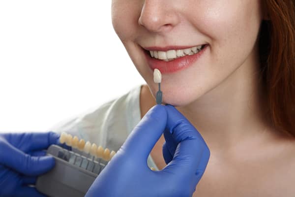 faccette dentali