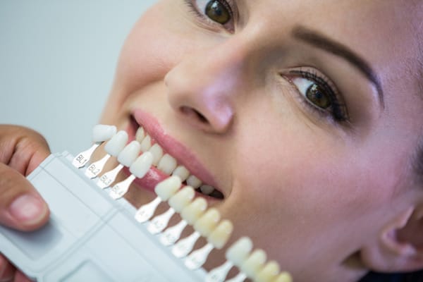 sbiancamento dentale